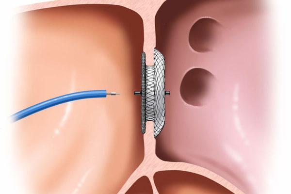 Transcatheter VSD Closure